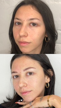 before and after photos of a woman with freckles